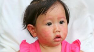 ผื่นขึ้นหน้าทารกอาจเกิดจากอาการแพ้